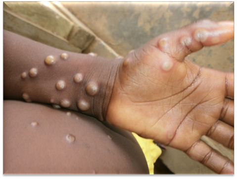 Nigeria Begins Rollout of 5,000 Mpox Vaccines as DRC Prepares for First Shipment of 65,000 Doses